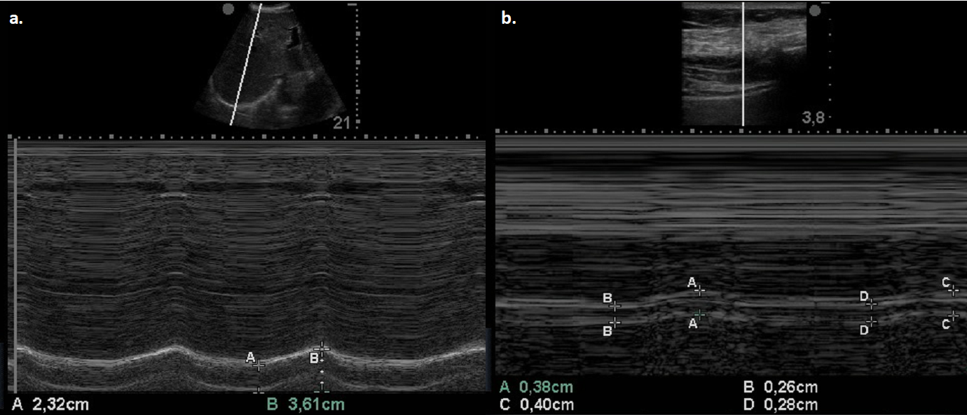 Figure 1. Two representative pictures in M-mode ultrasound of diaphragmatic displacement (a.) and thickening fraction (b.)